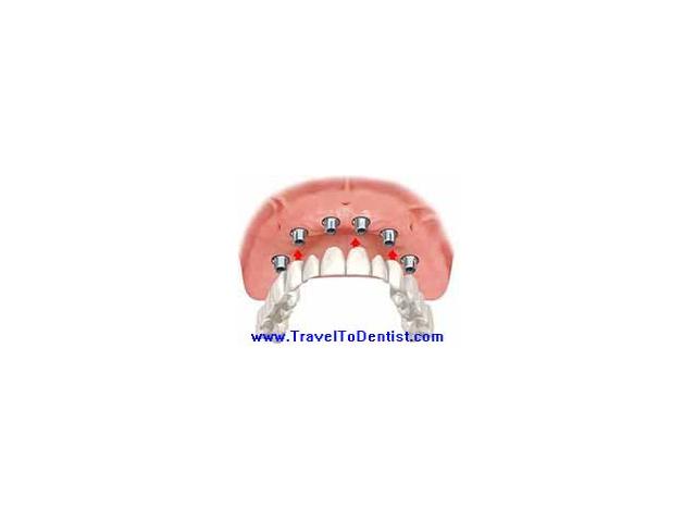 Implants dentaires! 1 dent en France = 4 dents en Moldavie